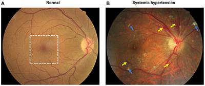 The Application of Optical Coherence Tomography Angiography in Systemic Hypertension: A Meta-Analysis